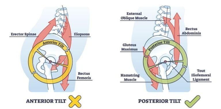 5 Exercises To Correct Anterior Pelvic Tilt To Relieve Back