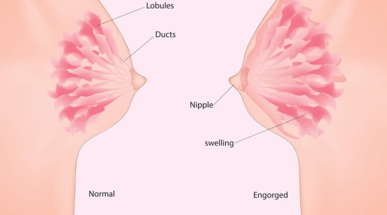 What Is The Difference Between A Blocked Duct And Blowout?