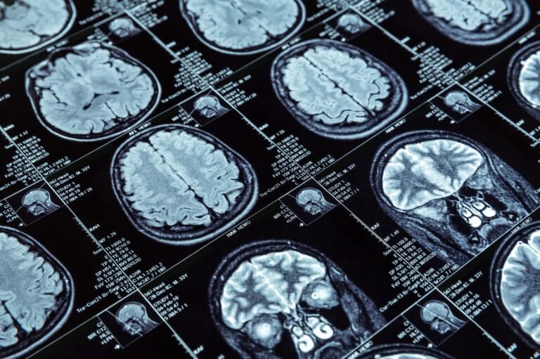 New Machine Learning Model Uses Mri Scans To Predict Onset