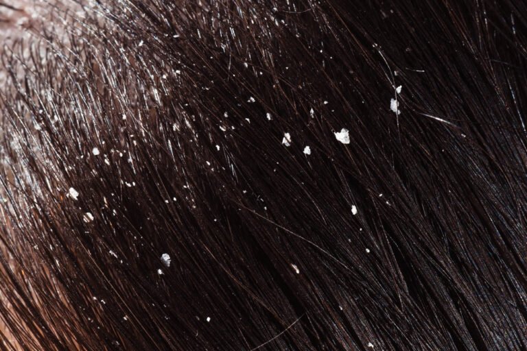 Choosing The Best Anti Dandruff Shampoos For A He – Mars