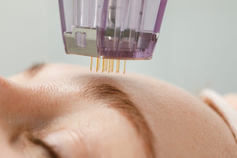 The Art And Science Of Microneedling In Dermatology And Aesthetics