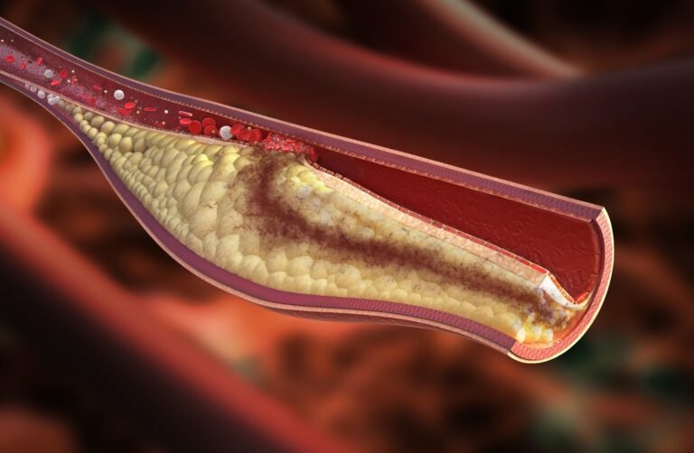 Elevated Atherogenic Index Is Associated With A Higher Risk Of