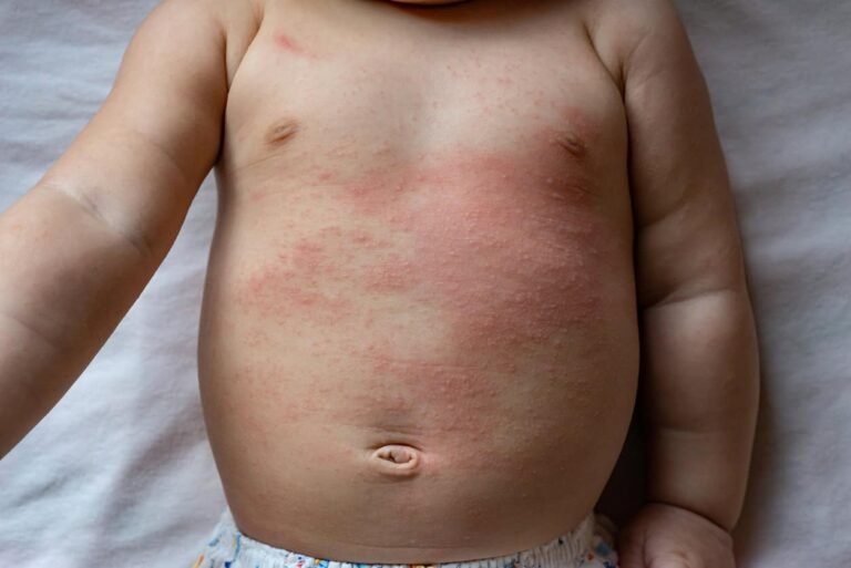 Baby Heat Rash: Causes, Types And Treatments