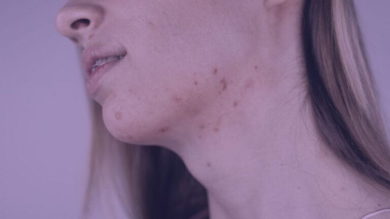 Does Pcos (polycystic Ovary Syndrome) Cause Acne?