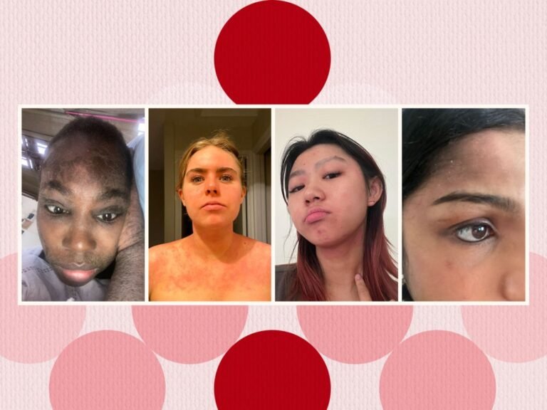 18 Photos Showing How Eczema Looks Different To Everyone