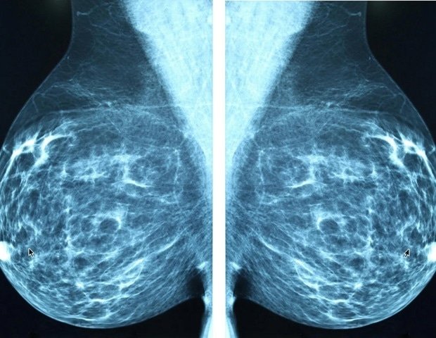 AI model outperforms breast density assessment in breast cancer risk stratification Ai Model Outperforms Breast Density Assessment In Breast Cancer Risk
