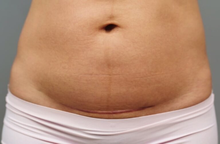 C-section scars that heal low in the uterus could affect fertility and pregnancy C Section Scars That Heal Low In The Uterus Could Affect