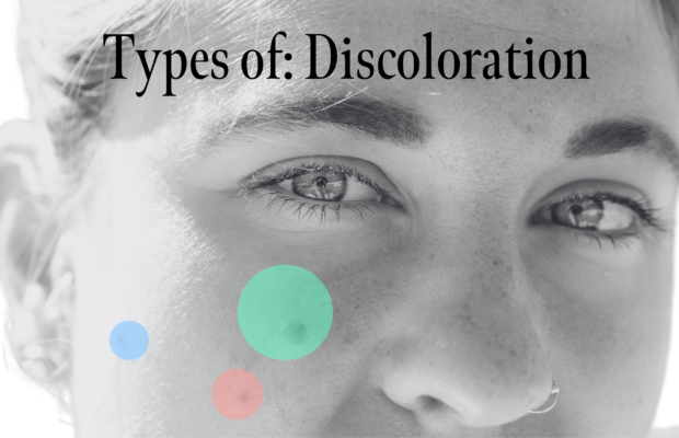 Types Of Skin Discoloration And How To Get Rid Of