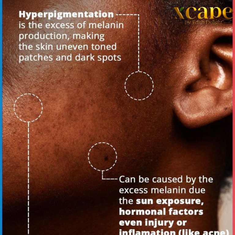 The Real Causes of Hyperpigmentation in Melanin Rich Skin and How Xcap – MYXCAPE The Real Causes Of Hyperpigmentation In Melanin Rich Skin And