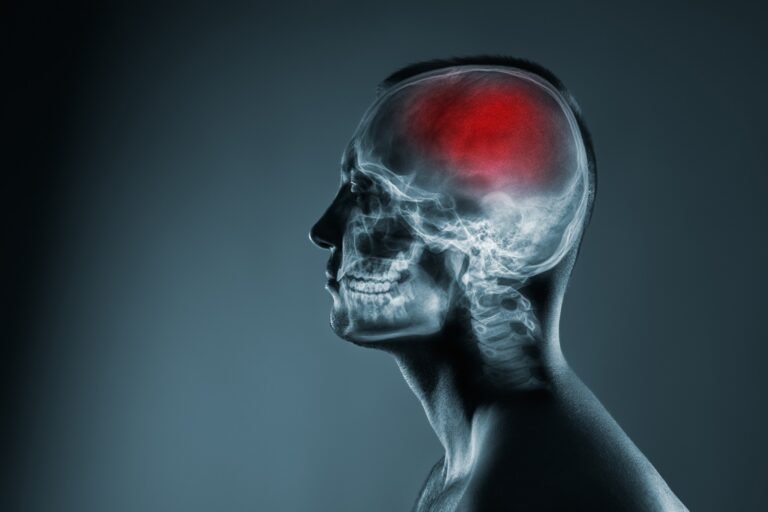A Key Factor In The Development Of Latent Stroke