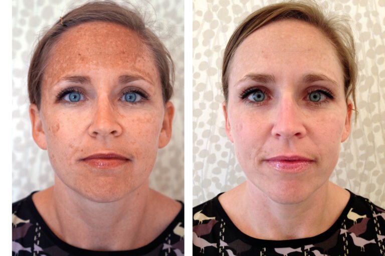 How I Did It: Fading Hormonal Hyperpigmentation Without Lasers