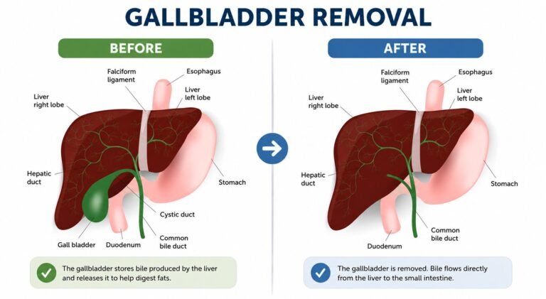 No Gallbladder? Here's What's Really Happening — And What To