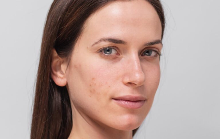 Why adult acne occurs and how to care for breakout-prone skin Why Adult Acne Occurs And How To Care For Breakout Prone