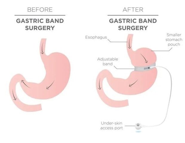 Bariatric surgery is safe, effective for obese teenagers and young adults Bariatric Surgery Is Safe, Effective For Obese Teenagers And Young