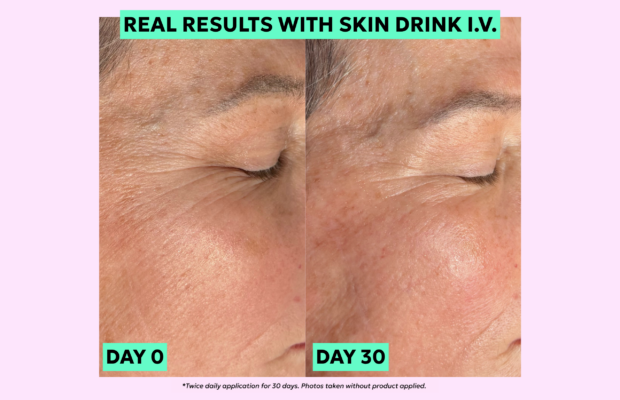 How I did it: I plump the skin without fillers How I Did It: I Plump The Skin Without Fillers