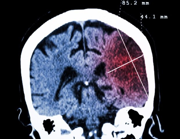 New virus insights lay foundation for treatment of JC polyomavirus infection New Virus Insights Lay Foundation For Treatment Of Jc Polyomavirus